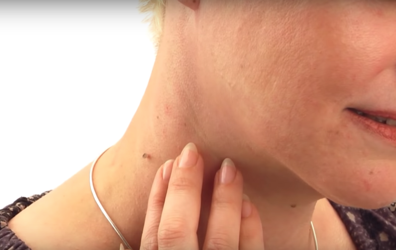 skin tags