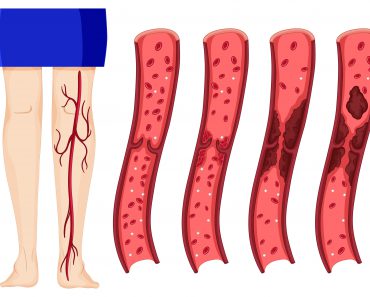 Your Body Warns You About a Blood Clot: 8 Hidden Signs You Must Never Ignore
